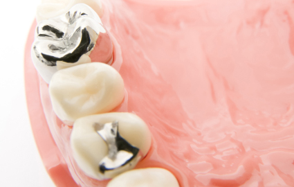 銀歯が保険の治療で使われる理由